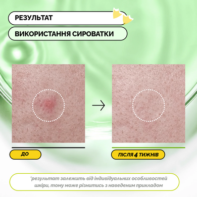 Тонер для очищення шкіри з азелаїновою кислотою 3% Anua Azelaic Acid 3 Cica Skin Clarifying Toner, 250 мл на KRKR.COM.UA